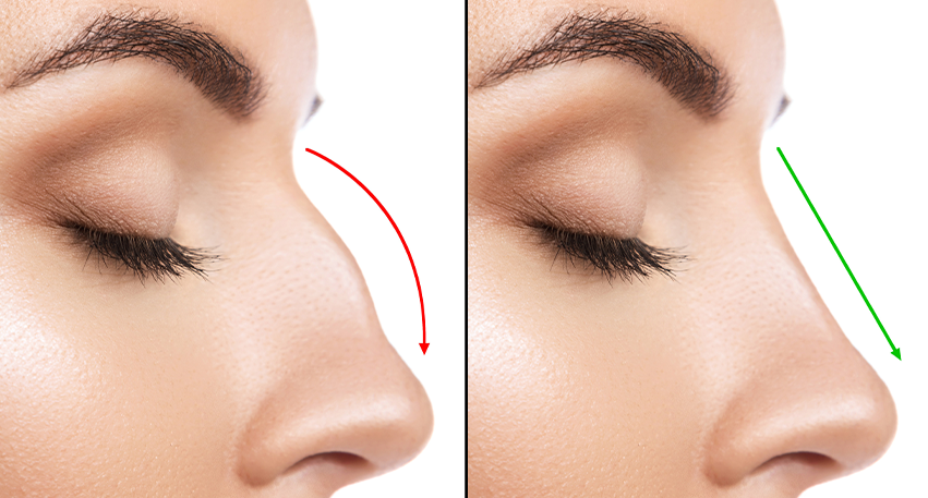 Dr. Shruti Sharma, ENT specialist doctor is trained and qualified to perform Septoplasty, medical procedure, at (Pedder Road and Tardeo) Mumbai.